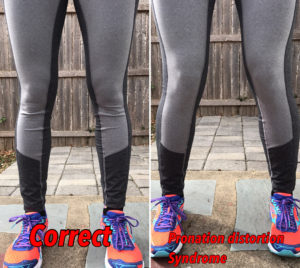Side-by-side comparison of two pairs of legs in athletic wear: left legs stand straight labeled "Correct," right legs show inward ankle tilt labeled "Pronation distortion syndrome." Both wear colorful sneakers.
